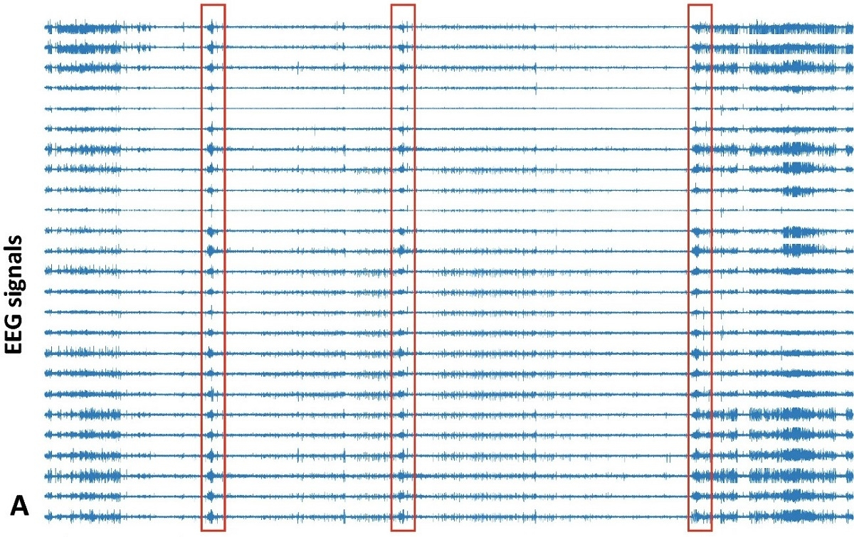 知识共享；科学报告12，文章编号11474，原始图像的一部分。在算法不同阶段获得的数据示例：脑电图数据，25个通道与3次癫痫发作（以红色框出）